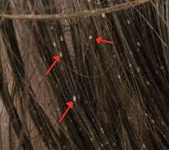 Trichomycosis nodularis or trichosporonosis nodosa. Hair Breakage And Spontaneous Hair Loss In 2 Sailors Aboard An Aircraft Carrier Consultant360