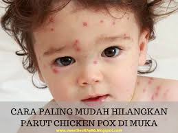 Korang dah pernah merasa kena chicken pox? Blog Safeni Feni Cara Paling Mudah Hilangkan Parut Chicken Pox Di Muka