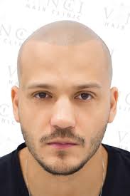 Scalp Pigmentation Results