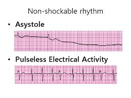 Image result for Pulseless Electrical Activity
