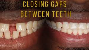 If your gap is related to more problematic orthodontic issues, your dentist may refer you to an orthodontist for braces or a removable retainer to close your. Closing Gaps Between Teeth With Braces Youtube
