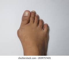Bunion Treatment: Over 1,570 Royalty-Free Licensable Stock Photos