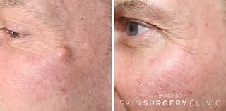 The little white lump inside the milium is very hard. Cyst Removal From 395 Leeds Bradford Skin Surgery Clinic
