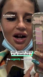 I Got Turkey Teeth At 18 Years Old