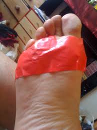 Just cut a small piece off that is slightly bigger than the verruca and stick it straight onto the skin. All About Trying To Get Rid Of My Huge Disgusting Verruca Tales From The River