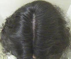 The severity of hair loss can vary from a small area to the entire body. Https Www Longdom Org Open Access Diffuse Hair Loss In A Young Female 2167 0951 1000122 Pdf
