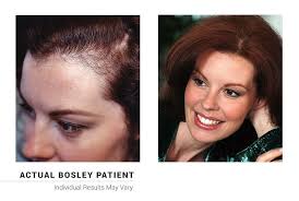 pin on female hair restoration