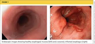 Image result for Pediatric Reflux
