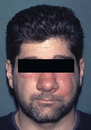 Rapidly progressive soft tissue infections