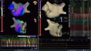 Aragonés spent the majority of his career as a player and coach at atlético madrid. Advisor Hd Grid Mapping Catheter Se Case Library Abbott