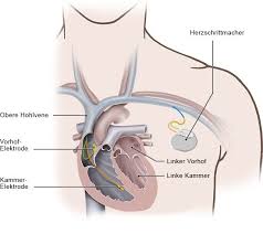 Doctori care au tratat blocul atrioventricular de gradul ii. Wie Wird Ein Av Block Behandelt Gesundheitsinformation De