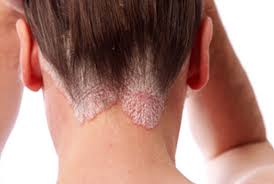 sănătate ca la carte totul despre psoriazis: Psoriazis Tot Ce Trebuie Sa Stii Cauze Simptome Tratament Viata Sanatoasa
