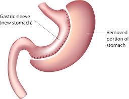 The gastric sleeve surgery uses the latest innovation in weight loss surgery and is our most popular option for those struggling with obesity and in particular those who suffer from. Bariatric Surgery Cost Sutured