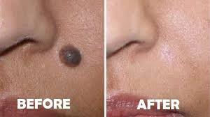 Tidak masalah menghilangkan tahi lalat tersebut, karena jumlahnya yang banyak, seperti yang dia sebutkan tentu memperburuk wajahnya. Mudah Dan Murah Tanpa Operasi Begini Cara Hilangkan Tahi Lalat Dengan Baking Soda Halaman All Blog Tribunjualbeli Com