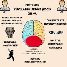 Image result for Posterior Circulation