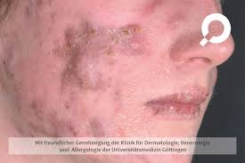 Wie sie effektiv vorbeugen und was gegen pusteln & juckreiz… Akne Dermanostic Hautlexikon