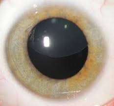 Marfan Syndrome American Association For Pediatric Ophthalmology And Strabismus
