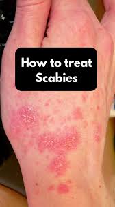 Image result for scabies bite