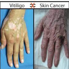 The skin cancer foundation believes that the best sunscreen is the one you are most likely to use, so long as it the sunscreens many people call chemical are actually uv organic filters. what does spf mean? I Have Vitiligo Will I Get Skin Cancer Vitiligo Clinic Research Center