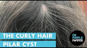 The reason that they are most commonly found on your scalp is because they develop from follicle roots which are in abundance on your scalp. The Curly Hair Pilar Cyst Youtube