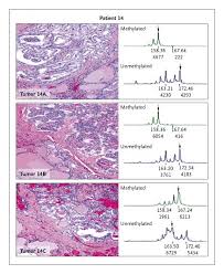 Up to 20% of patients will have involved lymph nodes at the time of diagnosis. Independent Clonal Origins Of Distinct Tumor Foci In Multifocal Papillary Thyroid Carcinoma Nejm