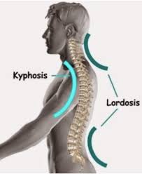 Lordosis And Spine Surgery Like Two Peas In A Pod Rocky Mountain Brain And Spine Institute