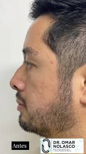 También tenemos armonización facial para ellos 😎, Luce un perfil perfecto,  rinomodelación con ácido hialuronico con duración de 10-12 meses., Acude a  valoración 442 33 8 66 03