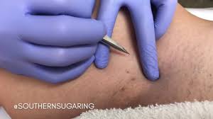 Here, with the help of a few trusted. A Southern Bikini Line Ingrown Hair Extraction Youtube