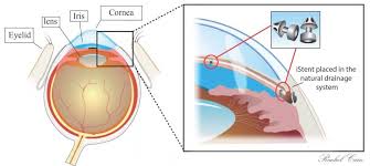 Image result for Cataract Extraction