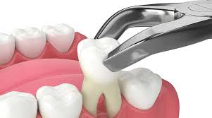 Image result for Tooth Extraction