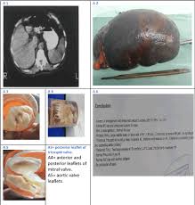 Image result for Splenic Abscess