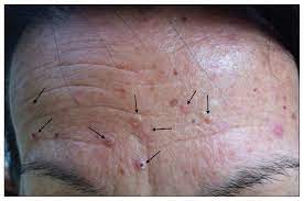 Muir Torre Syndrome Cmaj