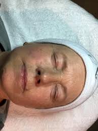 Great savings free delivery / collection on many items. Sylvia Ates Diamant Microdermabrasion Vorher Nachher Facebook