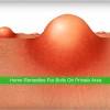 Belum ada komentar untuk ingrown hair bumps on vag lips. 3