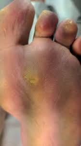 Image result for Corns