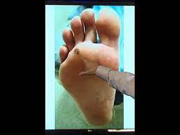 There are so many products out there that claim to remove warts, but unfortunately, not all of those products meet our high quality. Wart After Cantharidin Treatment Youtube