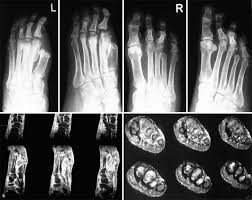 The coms one therapy system is intended to promote wound healing in chronic leg and foot ulcers. Charcot Fuss Springerlink