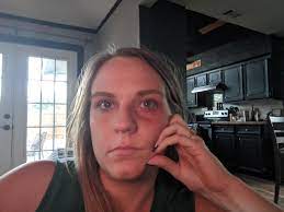 Ever Get A Migraine So Bad That You Get A Black Eye Yeah Me Too Migraine