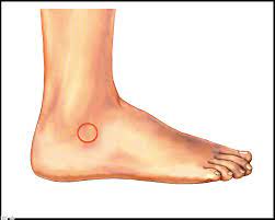 Sinus Tarsi Syndrome Footeducation