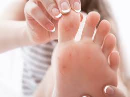 Toe infections come along with some common symptoms such as redness, pain, inflammation and warmth in the infected toes. Home Remedy To Get Beautiful Feet How Soaking Your Feet In Vinegar Water Can Help You Heal