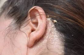 Trichodynia is a condition where the patient experiences a painful sensation on their scalp. Do You Have An Itchy Scalp 5 Common Problems And Fixes Health Essentials From Cleveland Clinic