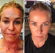 Chelsea handler is 45 years, 6 months, 15 days old. Chelsea Handler Looks Half Her Damn Age After Laser Facial See The Insane Pics The Hollywood Gossip