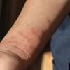 Irritation or dimpling of breast skin. 1
