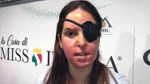La modelo italiana gessica notaro, de 28 años, finalista del concurso miss italia en 2007, fue atacada con ácido por su expareja y permanece en el hospital con pronóstico reservado, heridas graves y profundas, y con el riesgo de perder la vista. Gessica Notaro A Miss Italia Le Mie Cicatrici Sono Un Monito Contro Il Femminicidio Corriere It