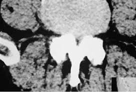 Στένωσις, contraído ) es un término utilizado para denotar la estrechez o el estrechamiento (patológico) de la luz. Tac Grave Estenosis Lumbar A Nivel L3 Con Superficie Minima Del Canal Download Scientific Diagram