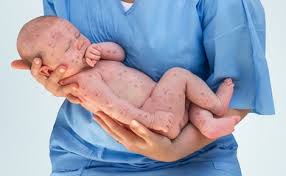 Denn dieser erhöht die wahrscheinlichkeit bei babys, ein atopisches ekzem (neurodermitis) zu bekommen. Kinderdermatologie Hauterkrankungen Rechtzeitig Erkennen