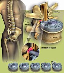 Protruzia nucleului pulpos spre ligamentul longitudinal posterior cu. Hernie De Disc Operata Titan Electrostimulare Move Flex Gel In Romania