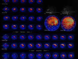 Image result for Nuclear Ventriculogram