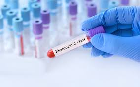 Image result for Rheumatoid Factor