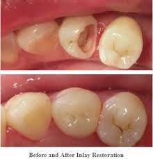 How Long Can Porcelain Inlay Last Dental Fillings Dental Restoration Tooth Filling